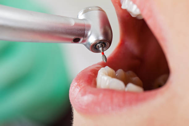 Best Emergency Tooth Extraction in Stafford Courthouse, VA